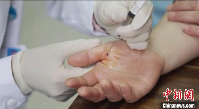 嘉善群眾體驗小針刀。　嘉善統(tǒng)戰(zhàn) 供圖